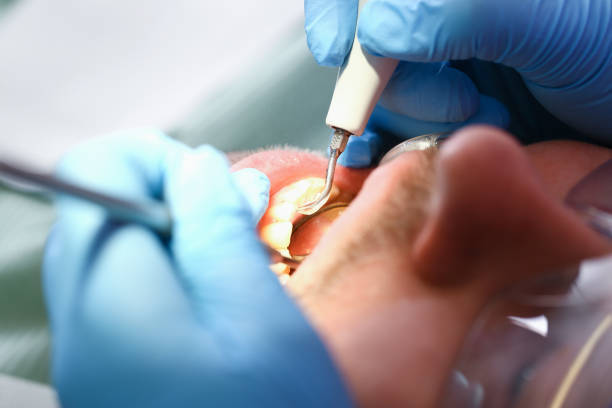 Best Emergency Tooth Extraction in St Ignace, MI